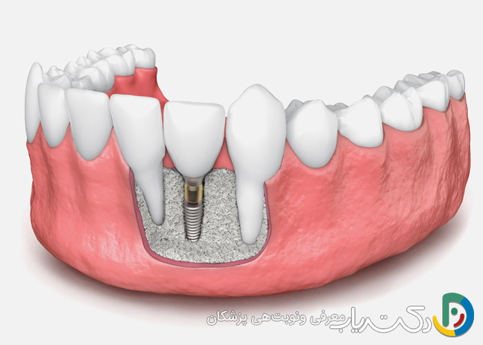 آیا ایمپلنت باعث تحلیل استخوان فک می شود؟