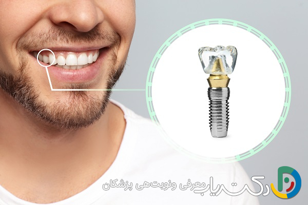 آیا ایمپلنت هم مانند دندان طبیعی دچار پوسیدگی می شود؟