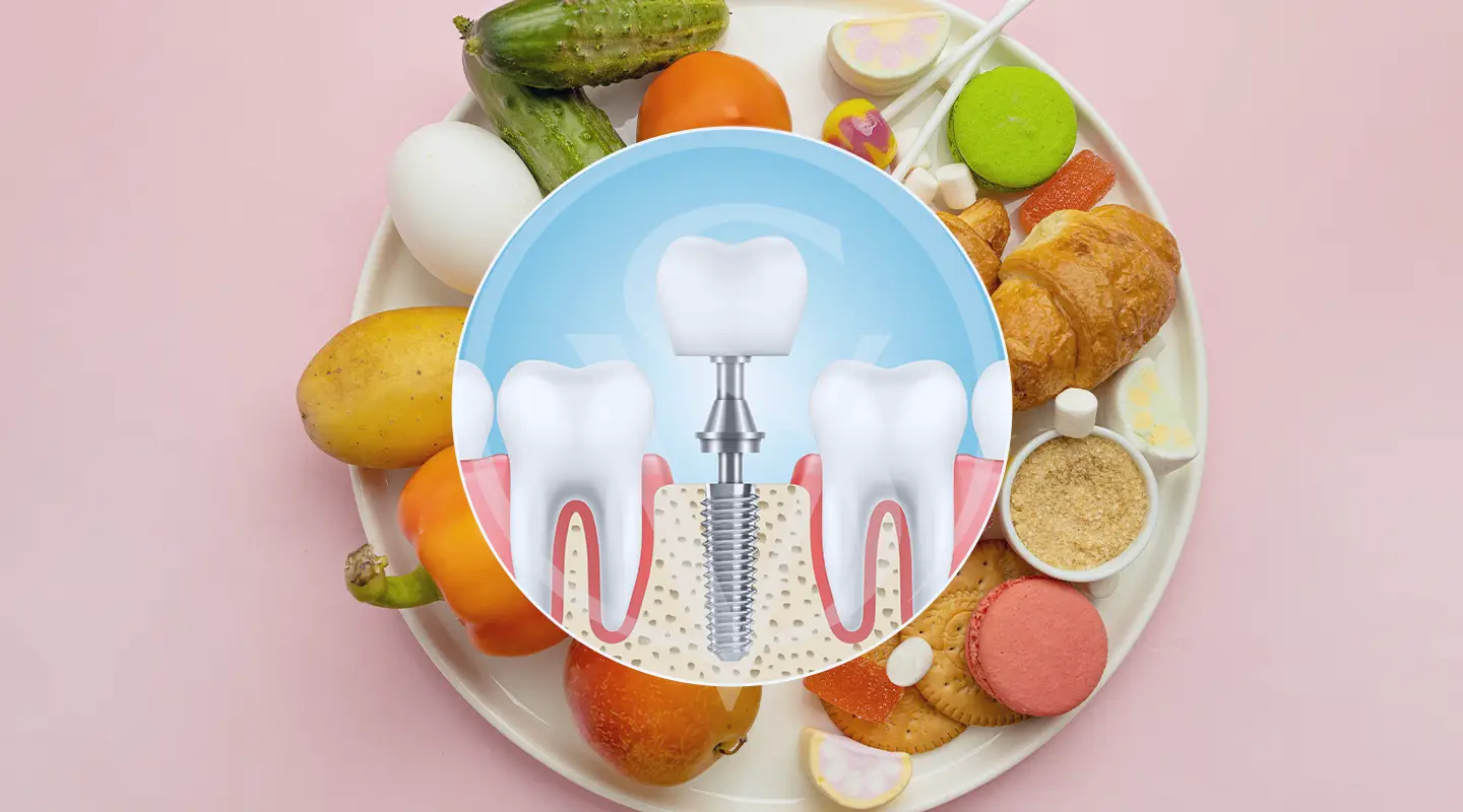 آیا لازم است رژیم غذایی خاصی بعد از ایمپلنت دندان رعایت کنیم؟