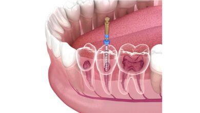 آیا باید پس از عصب کشی مراقبت های خاصی انجام دهیم؟