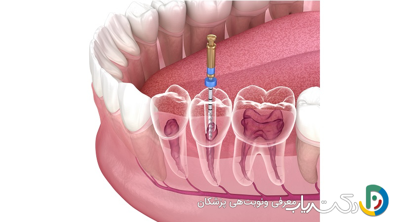 آیا باید پس از عصب کشی مراقبت های خاصی انجام دهیم؟