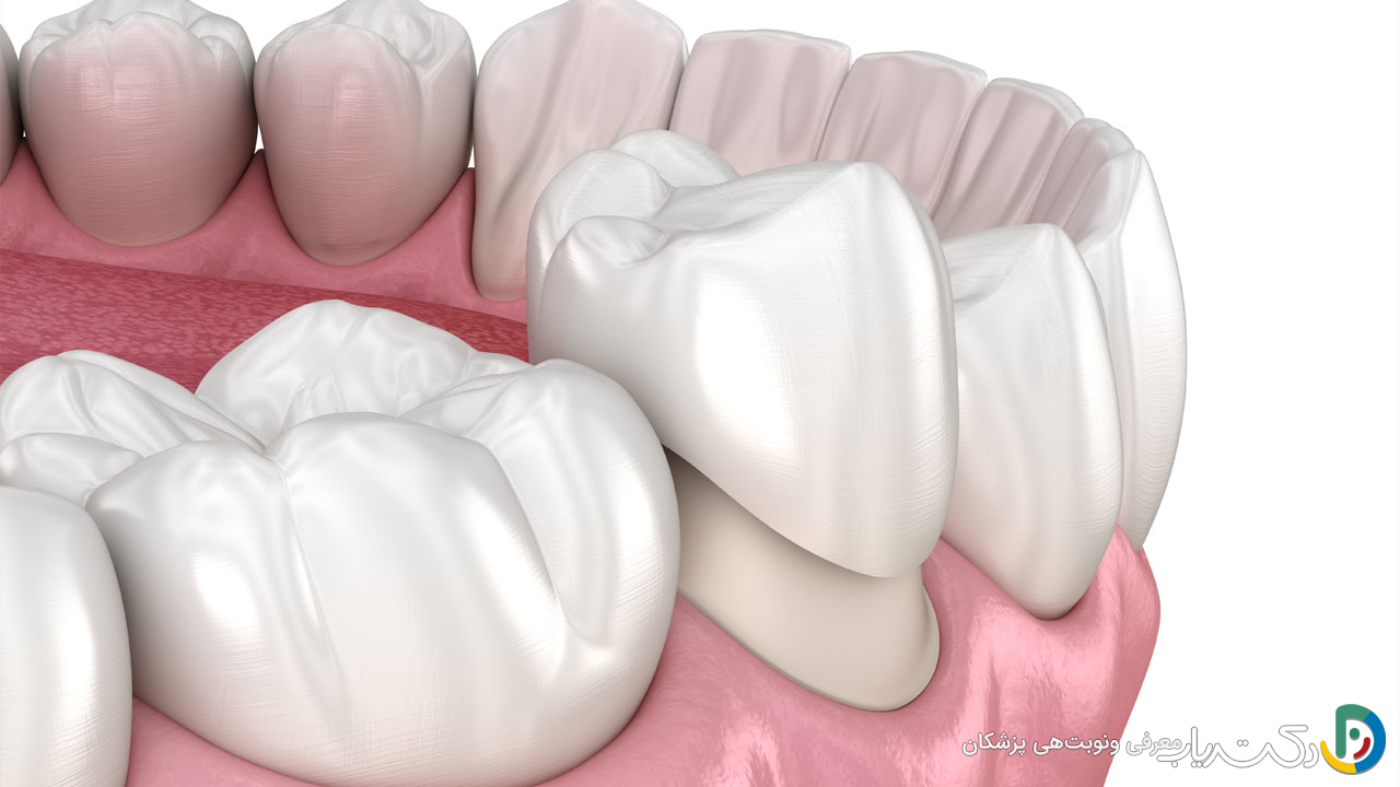 آیا روکش دندان نیاز به ترمیم دارد؟