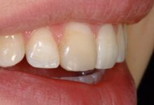 آیا کامپوزیت دندان باعث تغییر رنگ دندان ها می شود؟