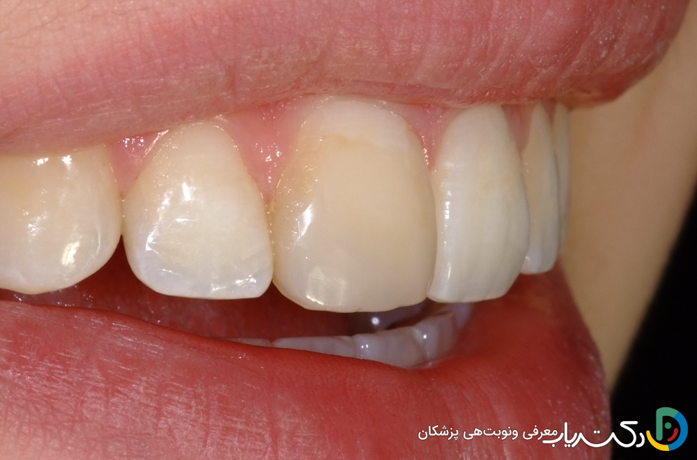 آیا کامپوزیت دندان باعث تغییر رنگ دندان ها می شود؟
