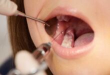 آیا ترمیم دندان به بی حسی نیاز دارد؟