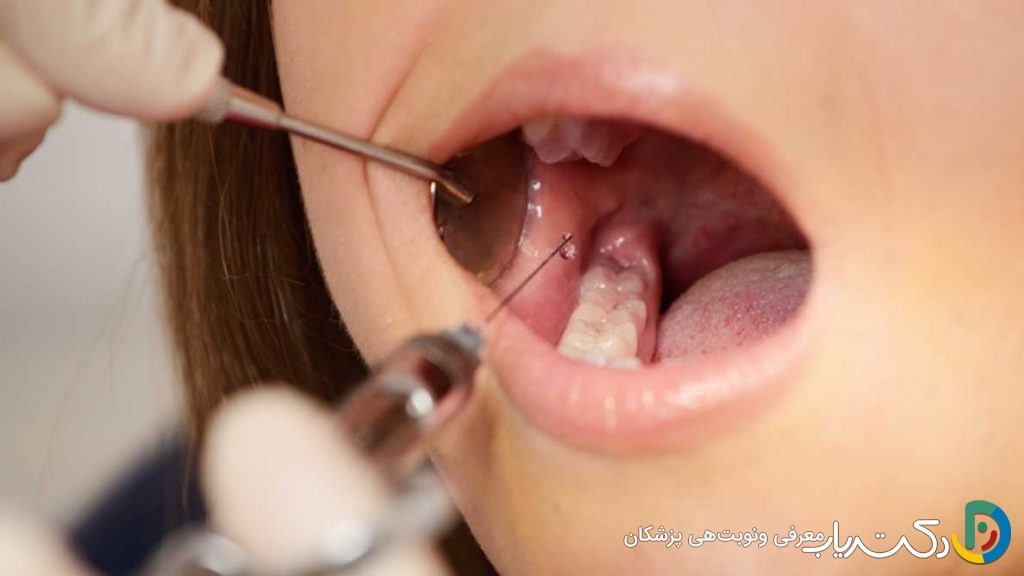 آیا ترمیم دندان به بی حسی نیاز دارد؟