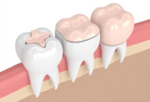 آیا ترمیم دندان به مراقبت خاصی نیاز دارد؟