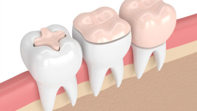 آیا ترمیم دندان به مراقبت خاصی نیاز دارد؟