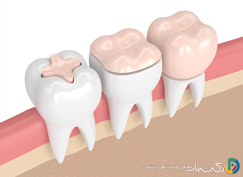 آیا ترمیم دندان به مراقبت خاصی نیاز دارد؟