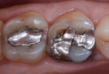 آیا ترمیم دندان به مرور زمان نیاز به ترمیم مجدد دارد؟