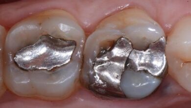 آیا ترمیم دندان به مرور زمان نیاز به ترمیم مجدد دارد؟