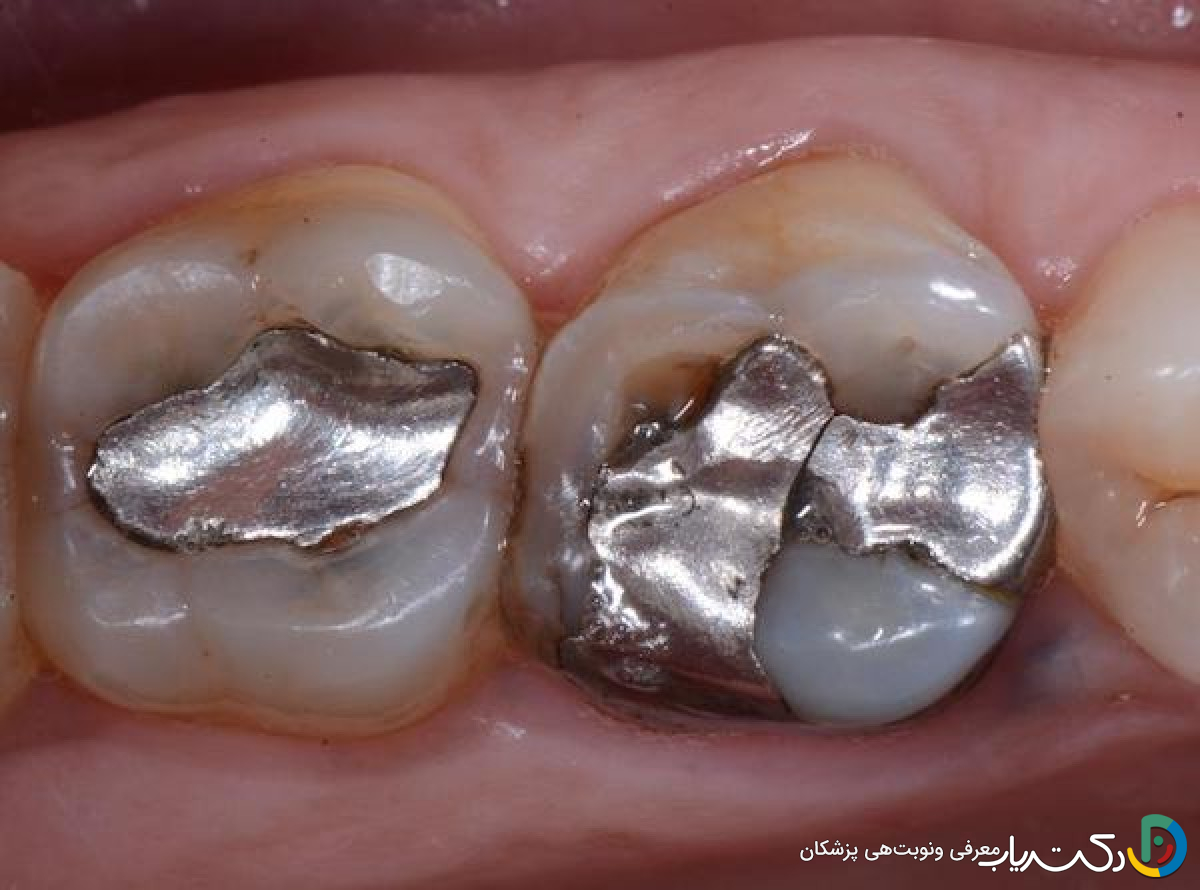 آیا ترمیم دندان به مرور زمان نیاز به ترمیم مجدد دارد؟