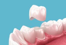 آیا نصب روکش دندان به بی حسی نیاز دارد؟