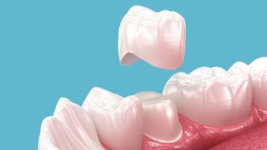 آیا نصب روکش دندان به بی حسی نیاز دارد؟