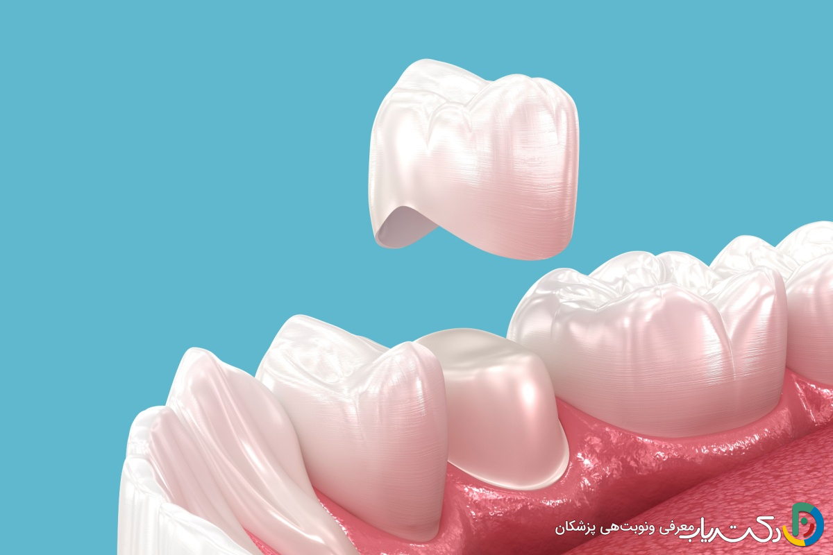 آیا نصب روکش دندان به بی حسی نیاز دارد؟