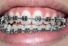 آیا ارتودنسی باعث بهبود گفتار می شود؟