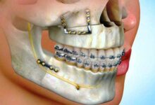 آیا ارتودنسی به جراحی نیاز دارد؟