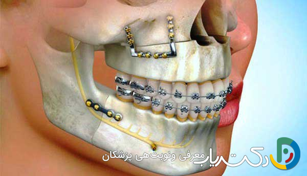 آیا ارتودنسی به جراحی نیاز دارد؟
