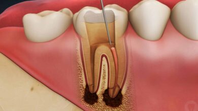 آیا عصب کشی دندان عوارض جانبی دارد؟