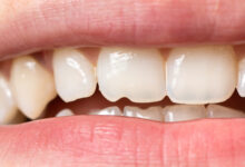 آیا بلیچینگ دندان باعث حساسیت دندان ها می شود؟