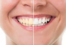 آیا بلیچینگ دندان درد دارد؟