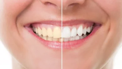 آیا بلیچینگ دندان درد دارد؟