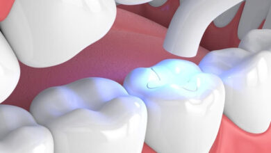 آیا هزینه کامپوزیت دندان در کشورهای مختلف متفاوت است؟