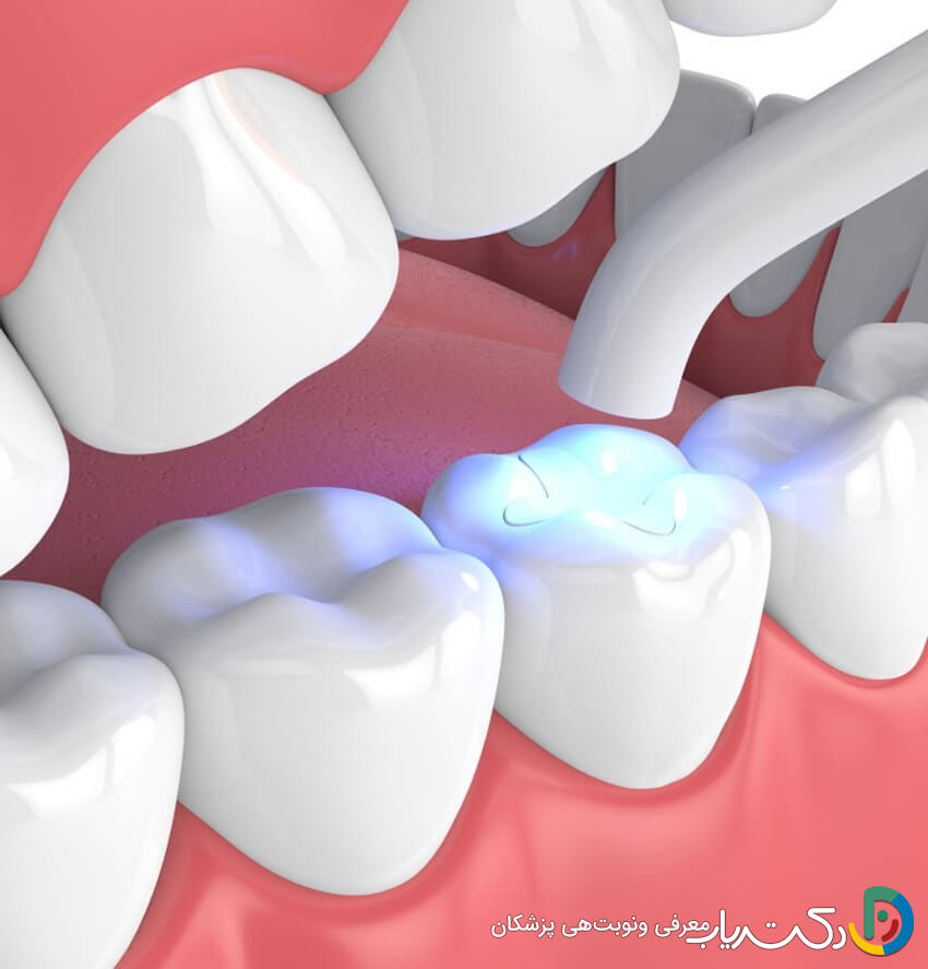 آیا هزینه کامپوزیت دندان در کشورهای مختلف متفاوت است؟