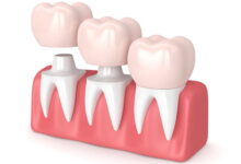 آیا هزینه روکش دندان در کشورهای مختلف متفاوت است؟