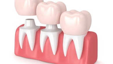 آیا هزینه روکش دندان در کشورهای مختلف متفاوت است؟