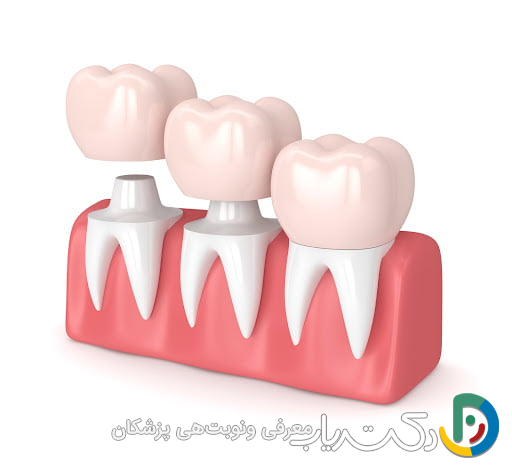 آیا هزینه روکش دندان در کشورهای مختلف متفاوت است؟