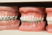 آیا هزینه ارتودنسی در کشورهای مختلف متفاوت است؟