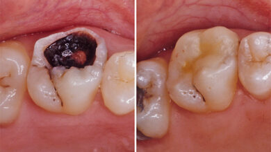 آیا دندان زیر کامپوزیت می پوسد؟ راهنمای کامل پیشگیری و درمان