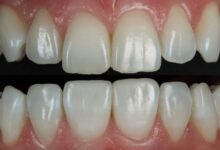 آیا کامپوزیت دندان آسیب نمی بیند؟