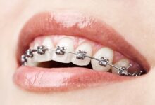 ارتودنسی ثابت چیست ؟ مزایا و معایب آن