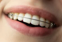 ارتودنسی فانکشنال چیست ؟ مزایا و معایب آن