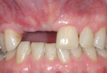 علت تحلیل لثه بعد از کشیدن دندان چیست ؟