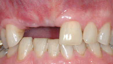علت تحلیل لثه بعد از کشیدن دندان چیست ؟