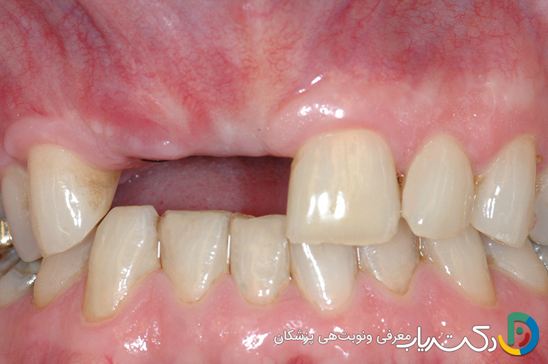 علت تحلیل لثه بعد از کشیدن دندان چیست ؟