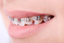 آیا ارتودنسی تنها برای زیبایی است یا تأثیرات سلامتی نیز دارد؟