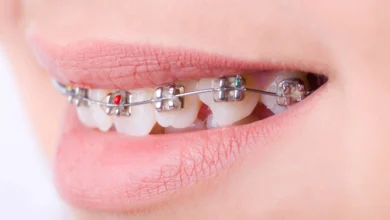 آیا ارتودنسی تنها برای زیبایی است یا تأثیرات سلامتی نیز دارد؟