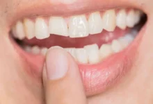 چگونه روکش دندان برای دندان های شکسته طراحی می شود؟