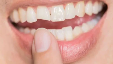 چگونه روکش دندان برای دندان های شکسته طراحی می شود؟