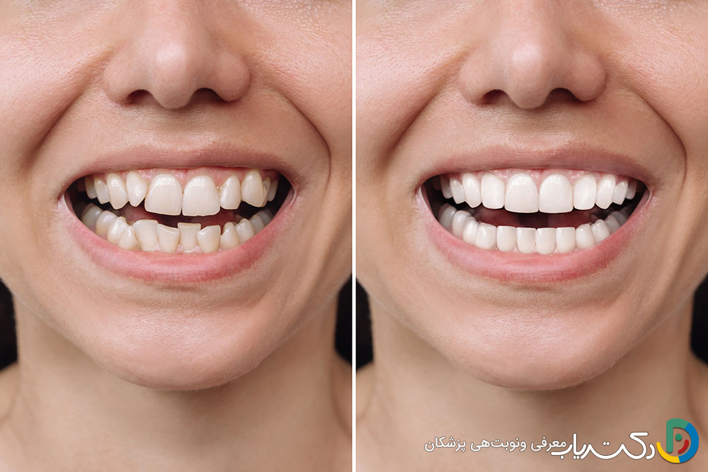 چگونه می توان از کامپوزیت دندان برای دندان های کج استفاده کرد؟