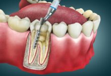 چگونه می توان از عفونت بعد از عصب کشی جلوگیری کرد؟