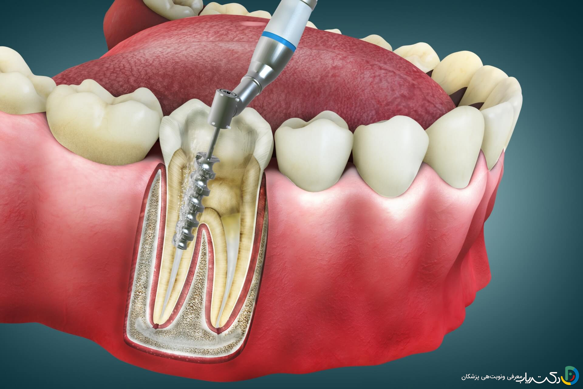 چگونه می توان از عفونت بعد از عصب کشی جلوگیری کرد؟