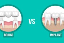 ایمپلنت دندان نسبت به درمان های دیگر مانند بریج چطور عمل می کند؟