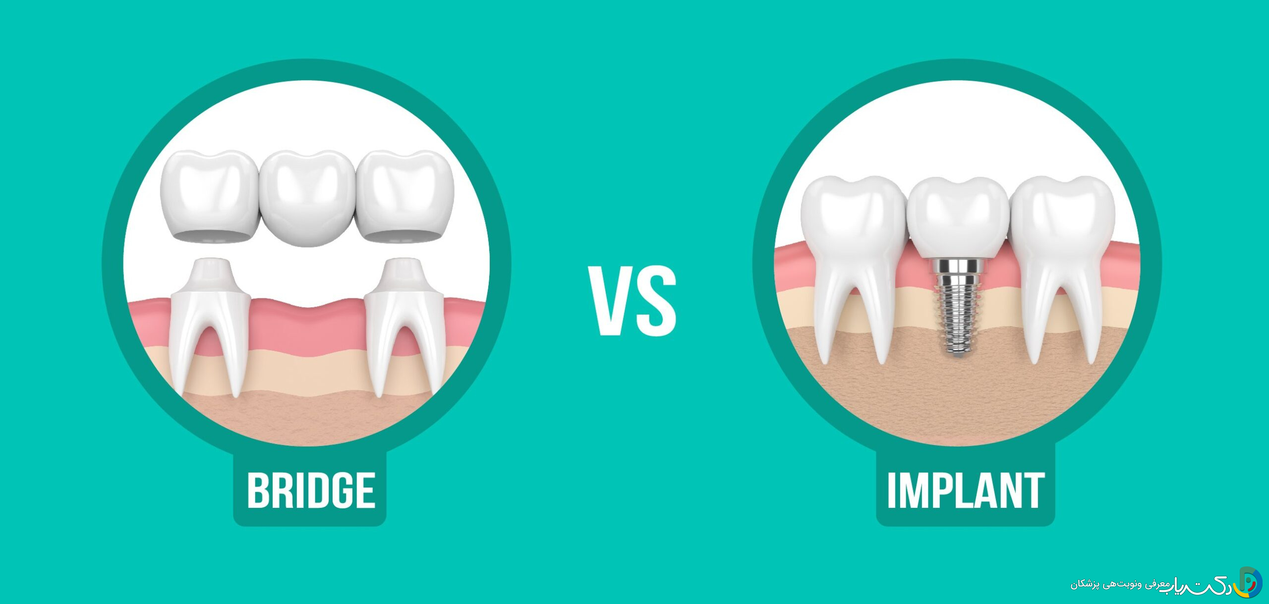 ایمپلنت دندان نسبت به درمان های دیگر مانند بریج چطور عمل می کند؟