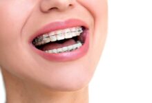 چگونه ارتودنسی باعث تنظیم دندان ها می شود؟