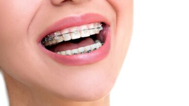 چگونه ارتودنسی باعث تنظیم دندان ها می شود؟